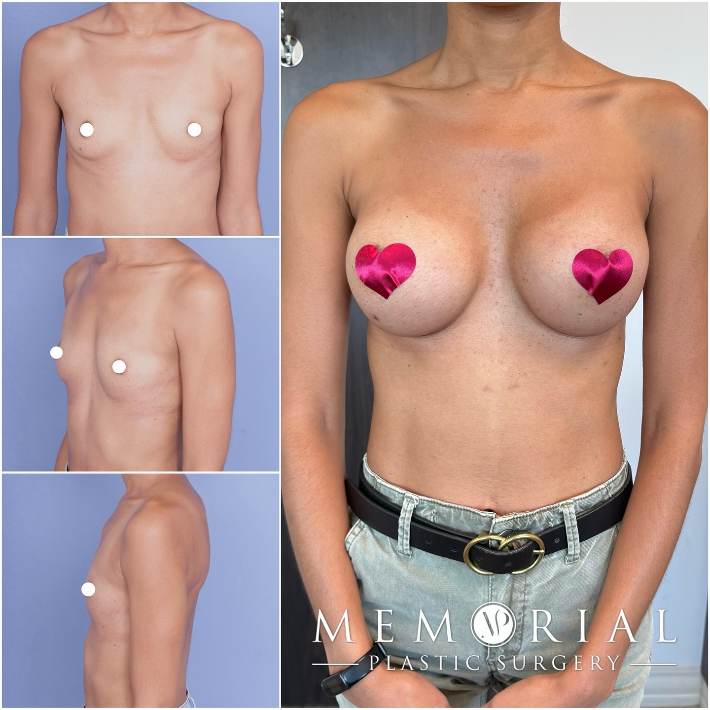 Gorgeous breast result at 3.5 months post-op 😍
I used 325cc high profile implants and they fit her small frame perfectly 👌🏼
Procedure: Breast Augmentation (incision under the fold)🔥
(Pre-Sx Wt: 105 Ht: 5’2 BMI: 19.2)
#breastaugmentation #boobjob #breastimplants #houstonplasticsurgeon @memorialplasticsurgery