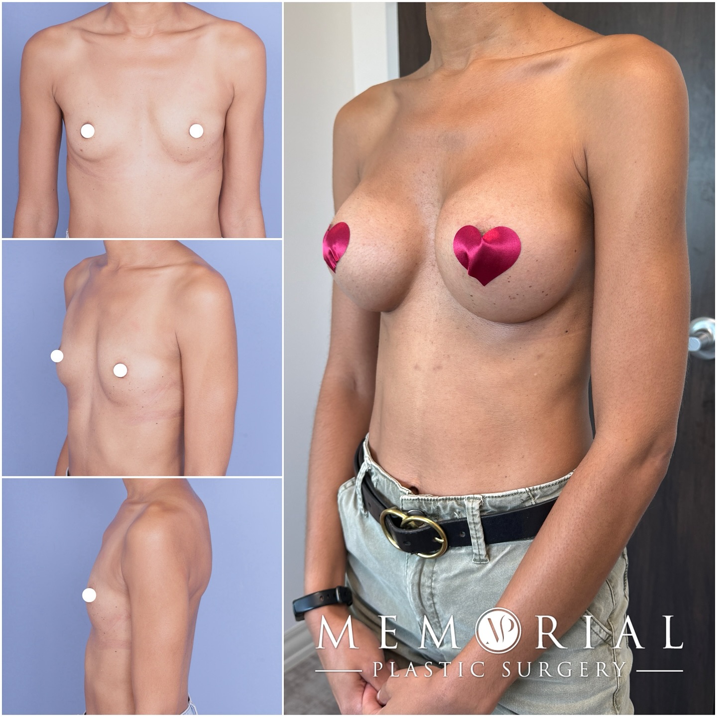 Gorgeous breast result at 3.5 months post-op 😍
I used 325cc high profile implants and they fit her small frame perfectly 👌🏼
Procedure: Breast Augmentation (incision under the fold)🔥
(Pre-Sx Wt: 105 Ht: 5’2 BMI: 19.2)
#breastaugmentation #boobjob #breastimplants #houstonplasticsurgeon @memorialplasticsurgery